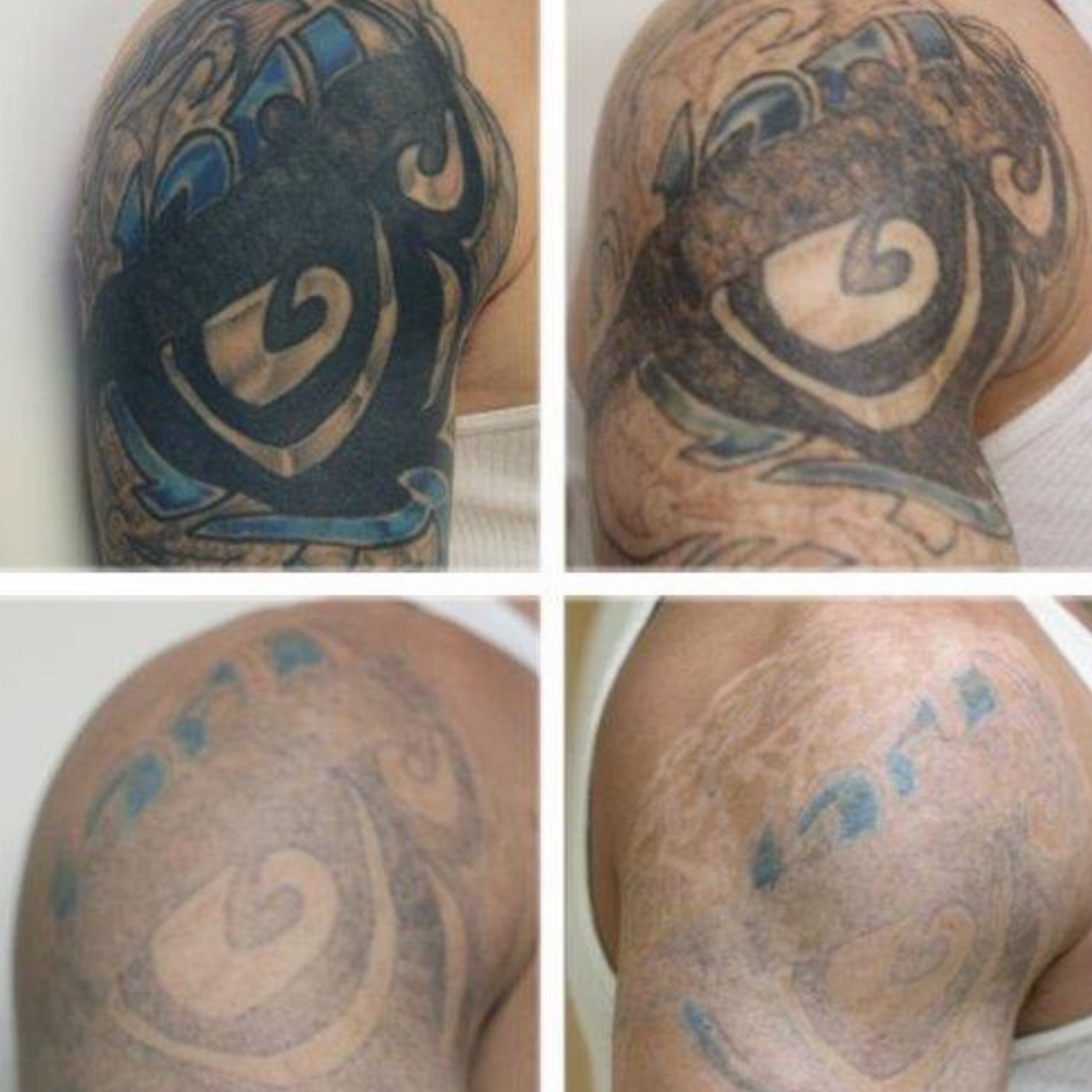 Laser Tattoo Removal